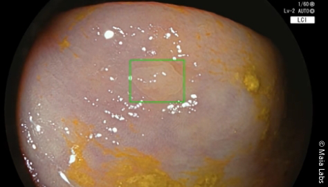 ColoMAIA II with precise detection