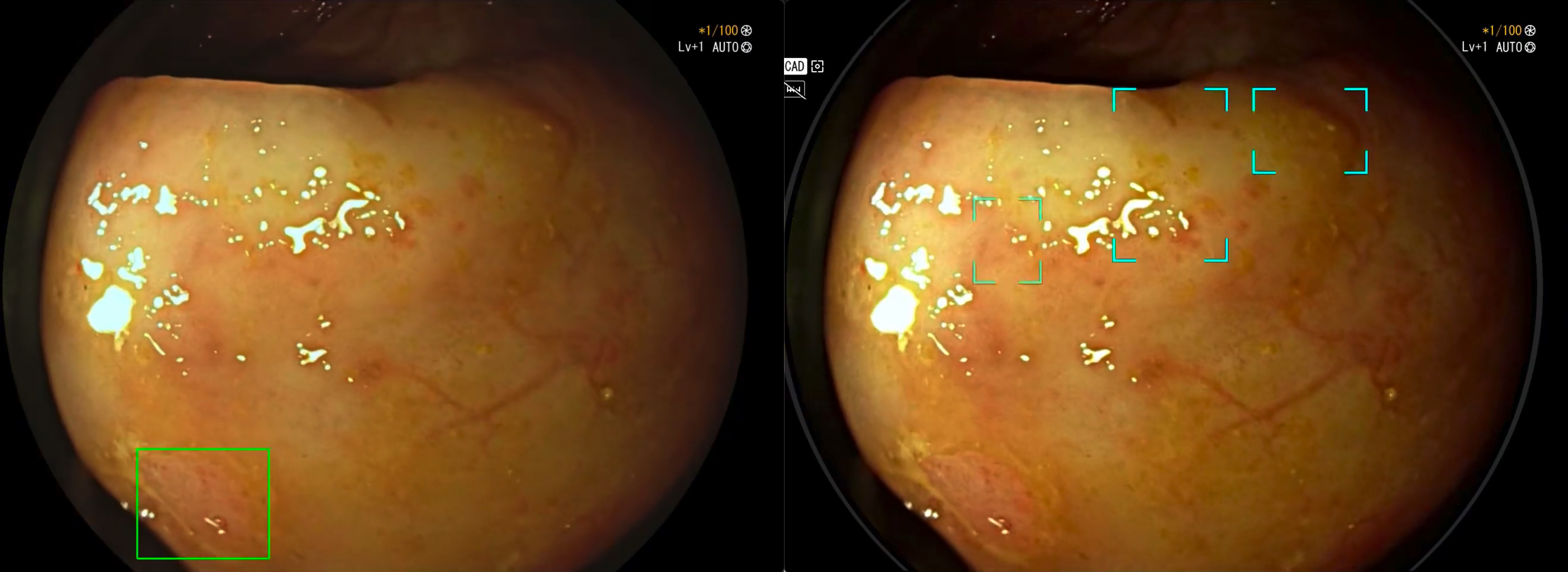 Side-by-side video comparison preview: ColoMAIA II vs. a competing AI detection system