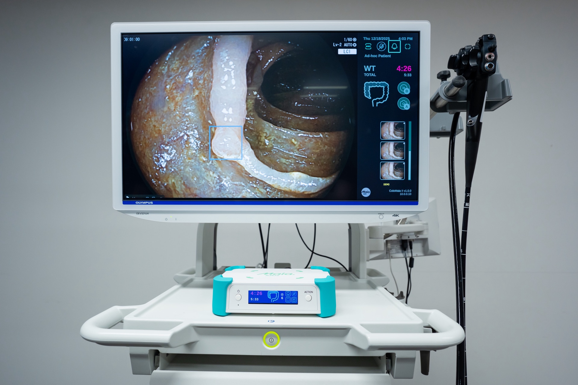 ColoMAIA II mounted on an endoscopy tower, showing real-time AI polyp detection on the monitor during a colonoscopy